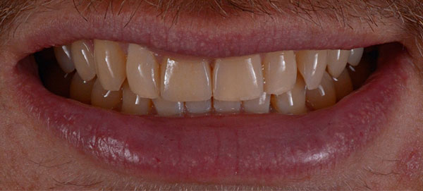 Teeth_after_crown_filling